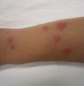 Treatment of Bed Bug Bites